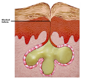 Acne Scar